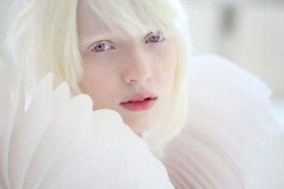 Хорошо ли быть альбиносом?