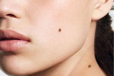 7 интересных фактов о родинках