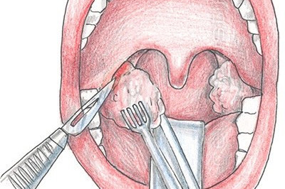 Стоит ли удалять миндалины?
