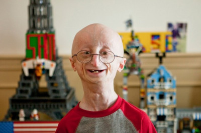 Что такое прогерия?