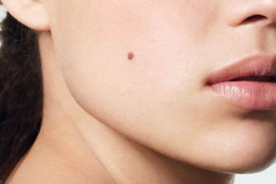 Откуда берутся родинки на коже человека?