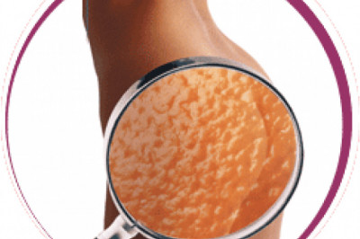 Интересный факт о целлюлите