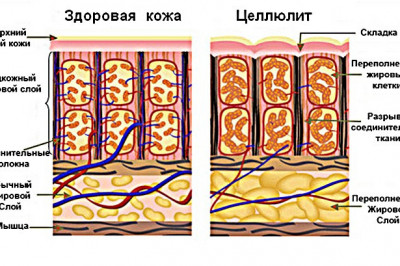 Как образуется целлюлит?
