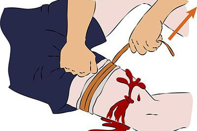 Что нужно знать о правилах накладывания жгута?