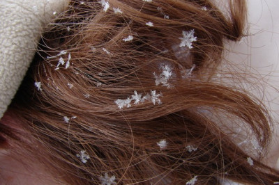 Что такое перхоть?