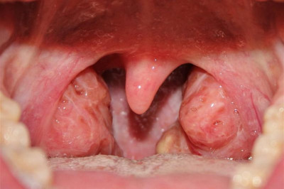 Удалять ,не удалять миндалины-вот в чем вопрос