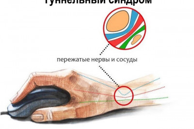 Почему появляется туннельный синдром?