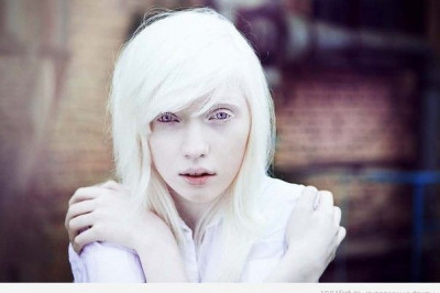 7 необычных фактов о альбиносах