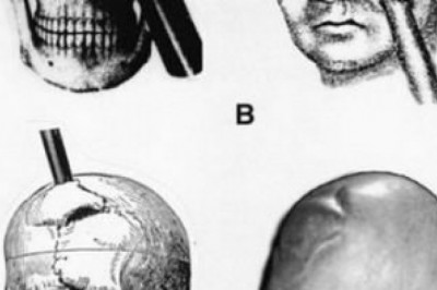 Финеас Гейдж- человек, выживший после потери части мозга