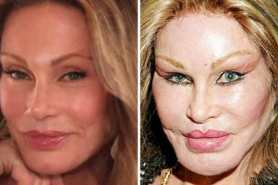 Джосслин Вильденштейн- жертва пластических операций