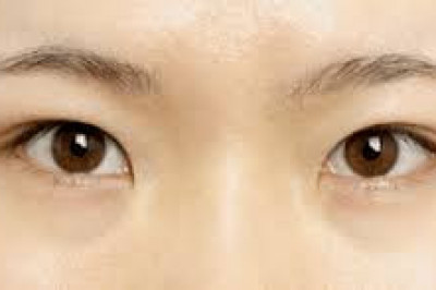 Что такое эпикантус и для чего он нужен человеку?