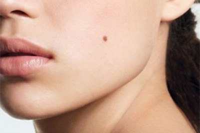 Что означают родинки на лице?