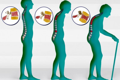 Какие привычные нам продукты могут вызывать остеопороз?