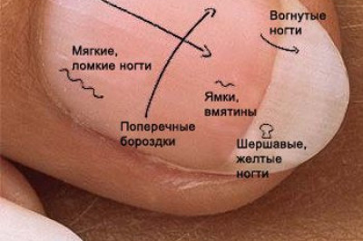 Как ногти могут рассказать о проблемах со здоровьем?