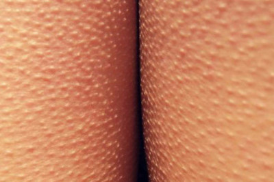 Почему человек иногда покрывается 