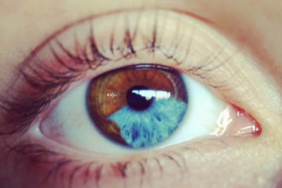 Гетерохромия- подарок судьбы, но никак не патология
