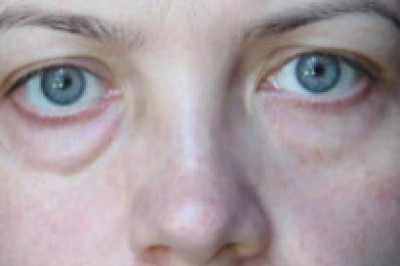 Откуда берутся мешки под глазами?
