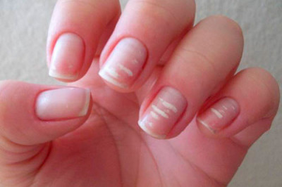 Почему появляются белые точки и полоски на ногтях?
