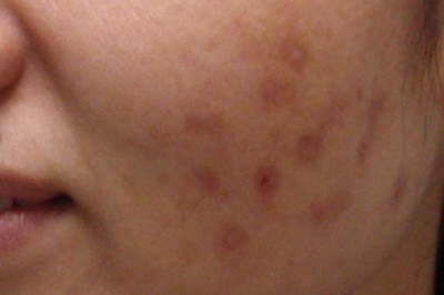 Как избавиться от пятен после прыщей?