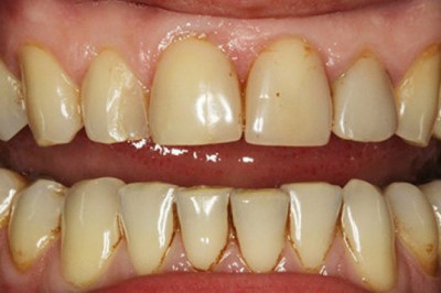 5 способов, которые предотвратят появления желтых пятен на зубах